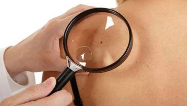 Kanser riski taşıyan benlerdeki 7 belirtiye dikkat