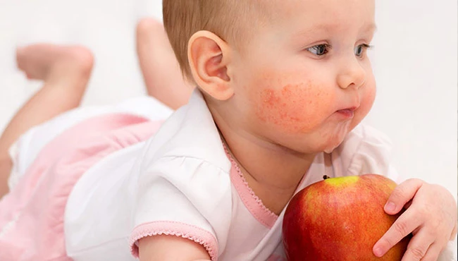 Çocuklarda besin alerjisine karşı 7 etkili yöntem