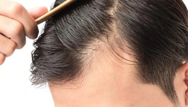 Saç dökülmesine karşı modern çözümler