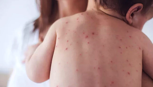 Çocuklarda yaz alerjisini tetikleyen 8 hata!